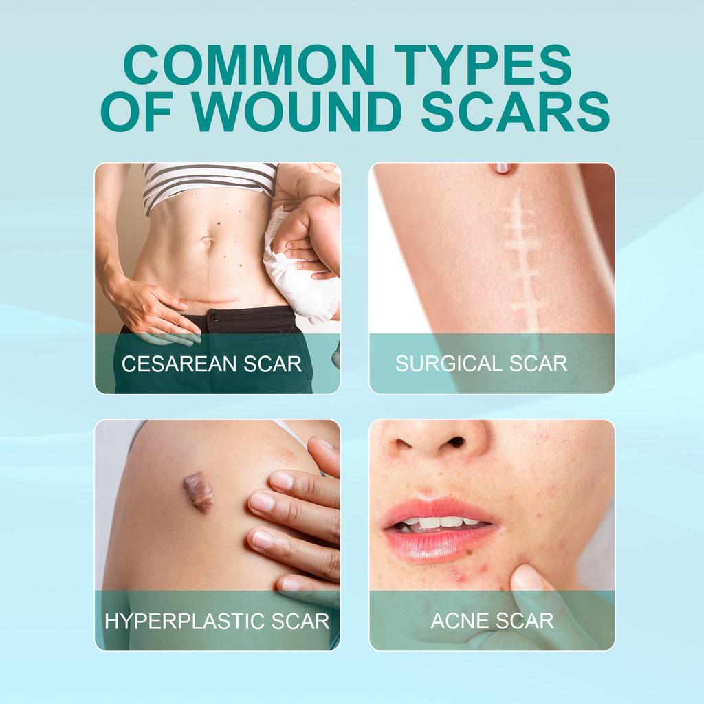 South Moon Scar Care Spray Smooth Skin Healing Reduce Burn Scars Pregnancy Marks