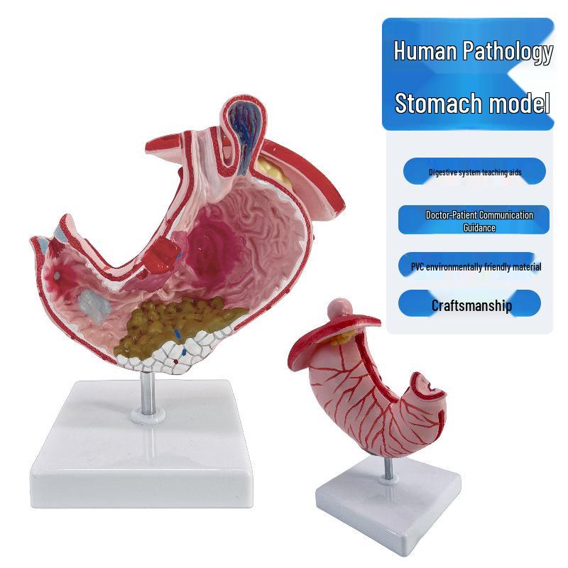 Pathological Human Stomach Anatomy Model for Teaching Pathological Stomach Model