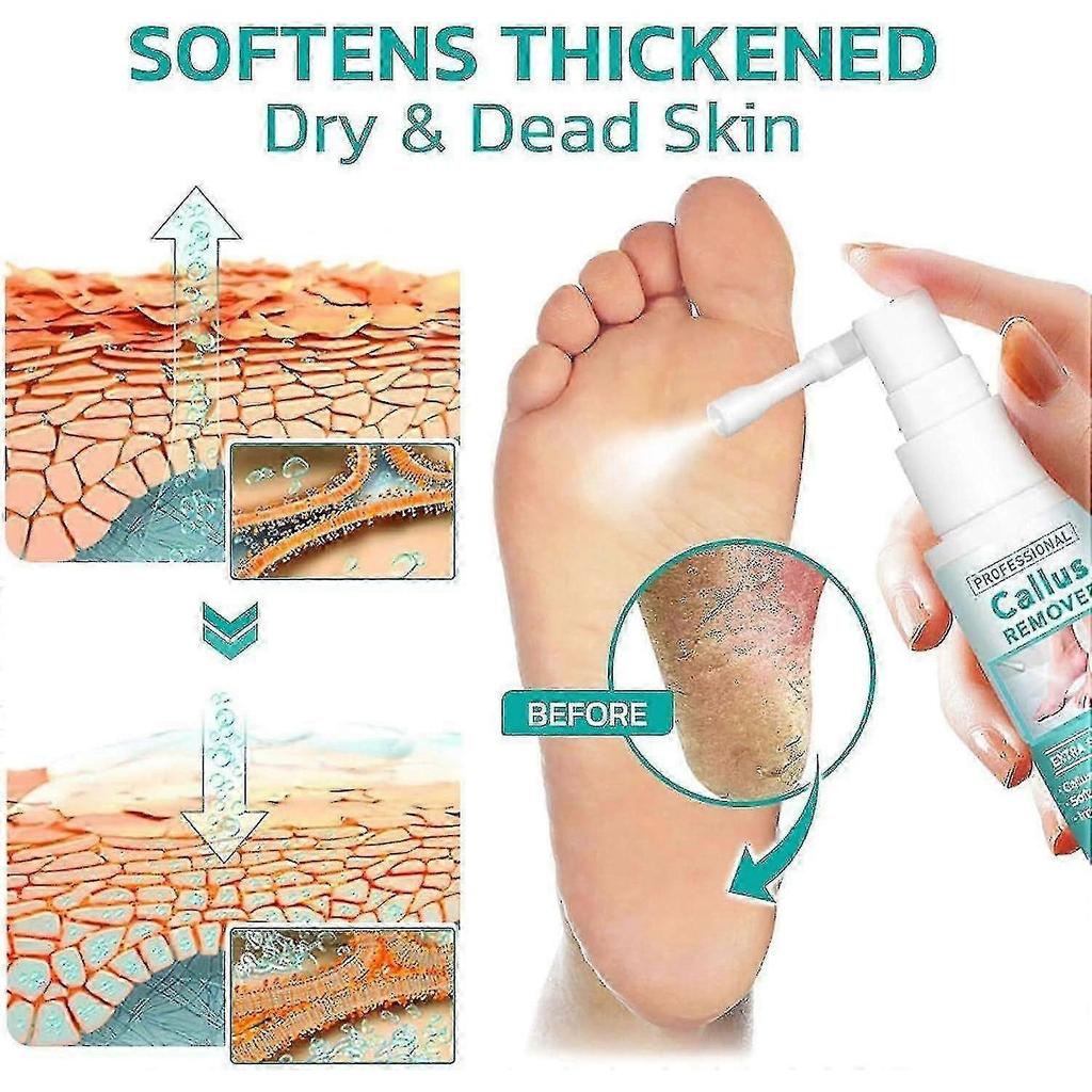 1-3PCS Professional Callus Remover Extra Strength Spray, Foot Callus Removal Spray, Instant Foot Peeling Spray Warding Off Foot