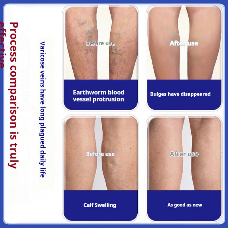 Varicose Veins Special Plaster Cold Compress Gel Earthworm Legs Old Rotten Legs Vascular Blockage Dredging Imported Medicine