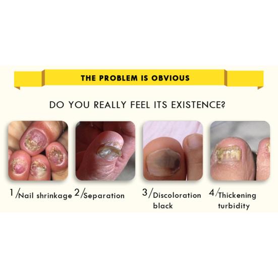 OEDO Nail Treatment Essence Oil Moisturizing Fungus Removal Foot Care Liquid