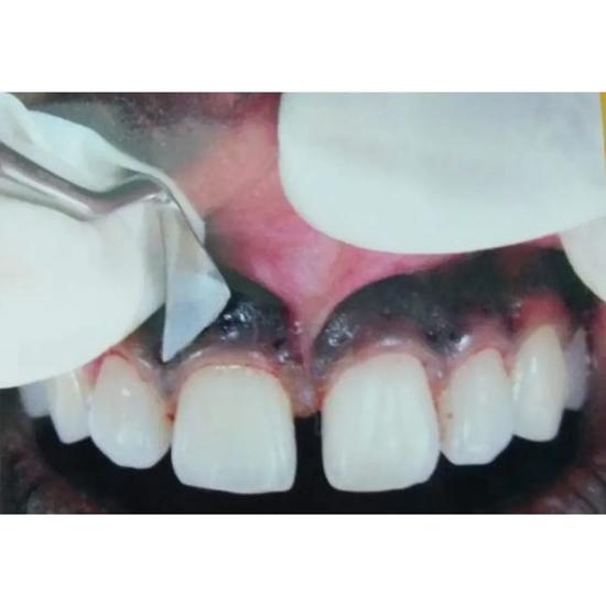 GDC Kirkland Knife #6 (Kk15/16)