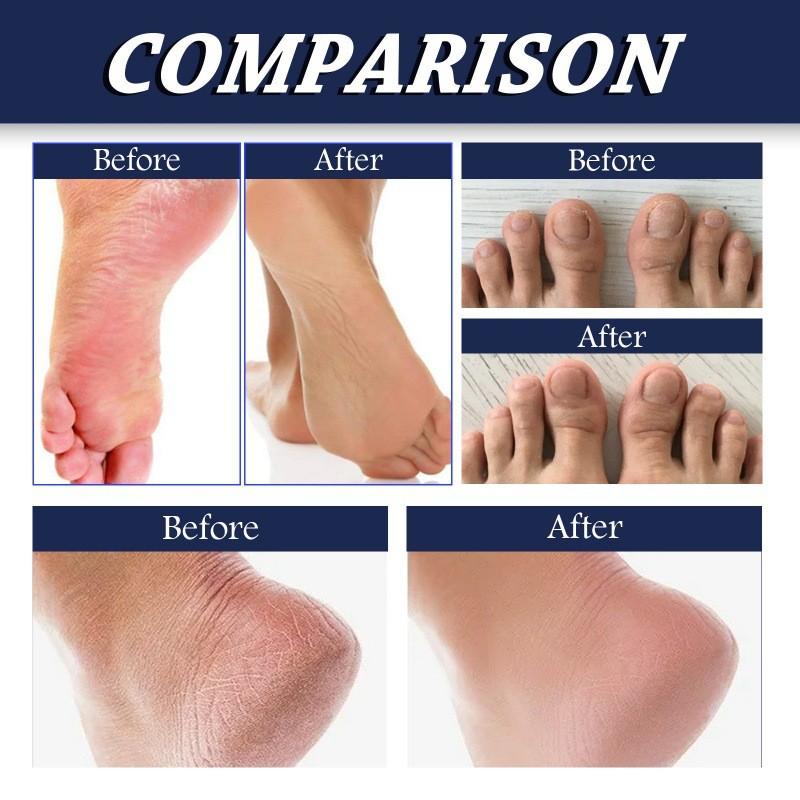 Eelhoe Foot Care Liquid Moisturizing Spray For Softening Rough Cracked Skin