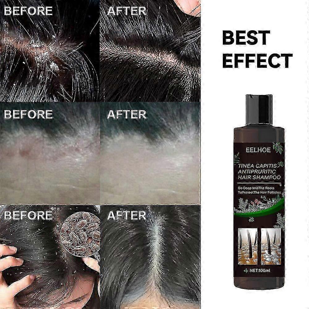 Mild Sulfate-Free Shampoo for Sensitive Scalps with Dermatitis Relief