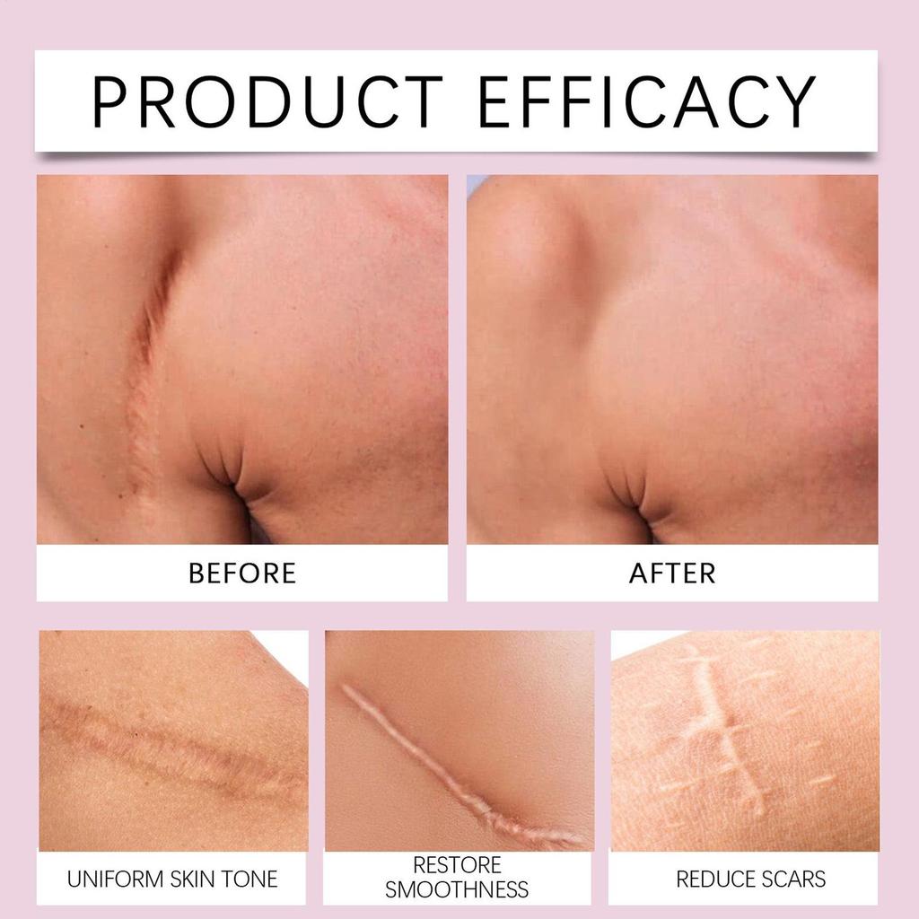 Silicone Scar Patch 4x150cm Waterproof Keloid Removal Strip Effective Scar Therapy Self-Adhesive Tape for Surgical Acne Burn