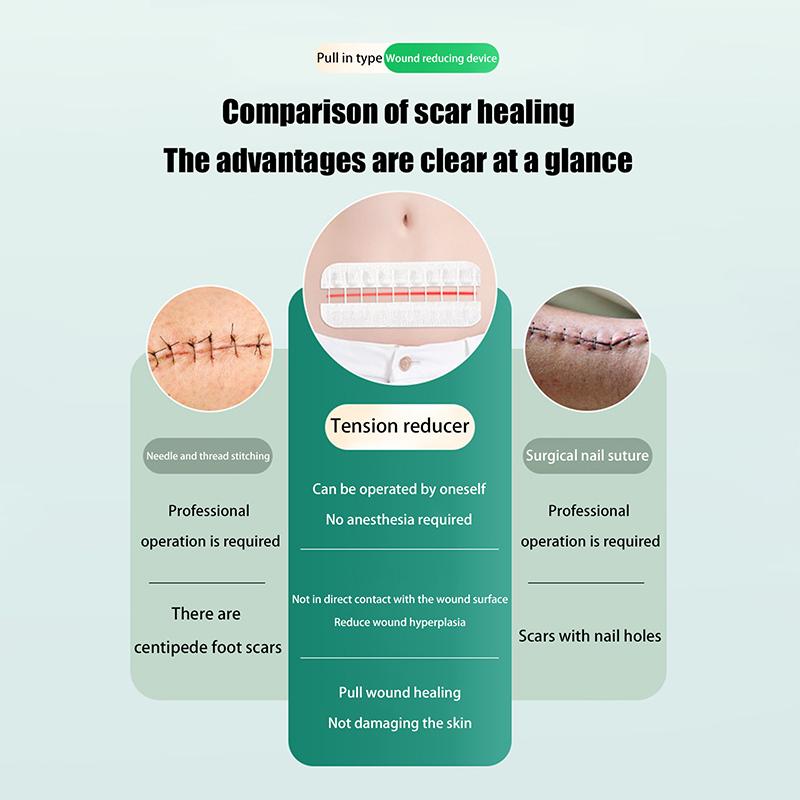 1 Sheet Fast Suture Zipper Band-Aid Zipper Tie Wound Closure Patch Hemostatic Patch Wound Outdoor Portable