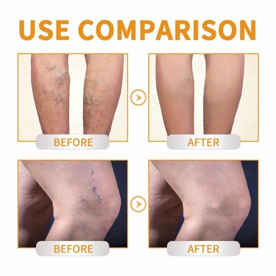 60G Varicose Vein Cream Natural Relief Promotes Healthy Circulation Vitamin K Cream for Leg Soreness Swelling