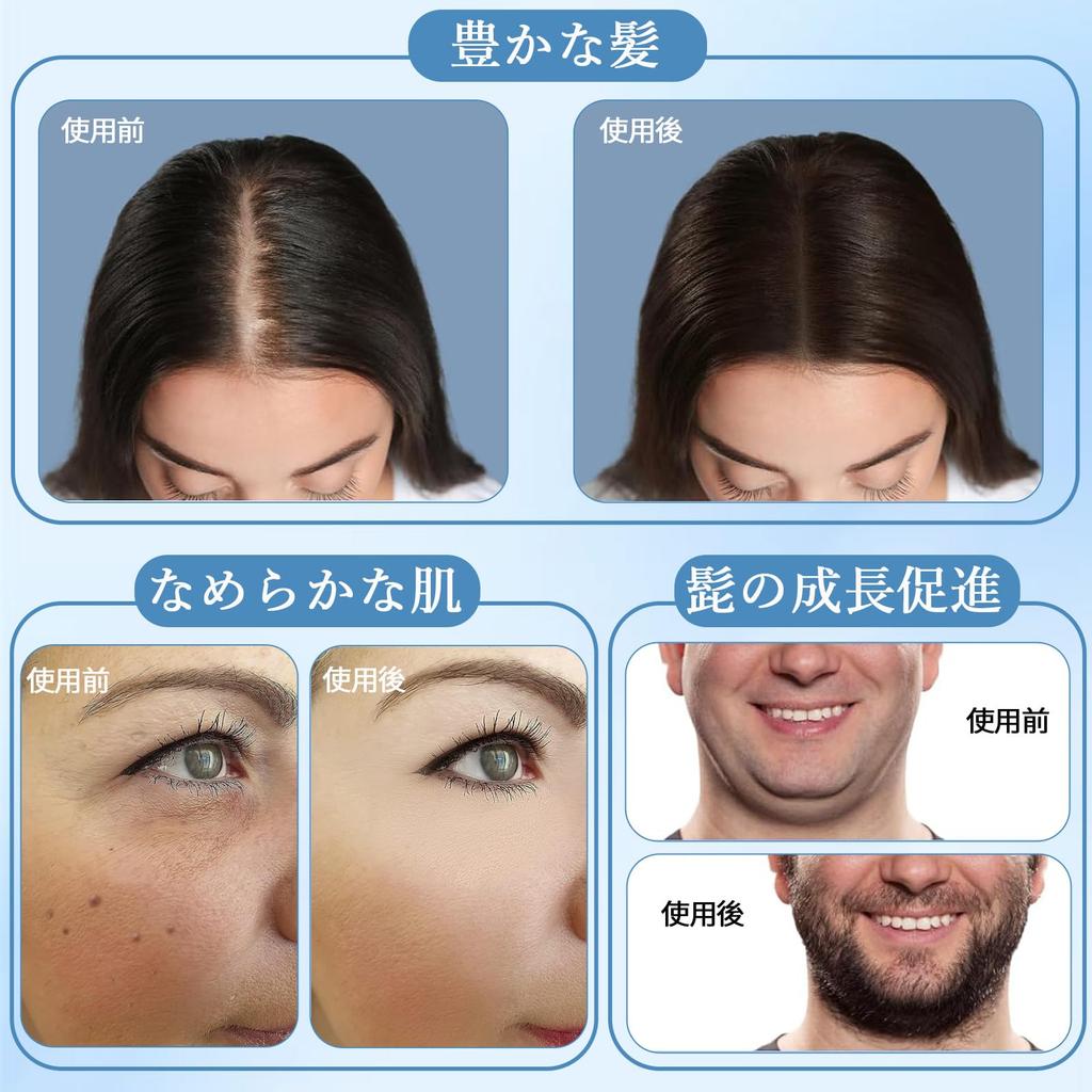 SrDiot Derma 140 Adjustable from Derma Roller for Cosmetic Acupuncture and for Skin Scalp Dark Thinning Pore Face Unisex Stamp, Needles, 0-3.0mm,