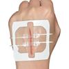 Zippered Suture-Free Tape Closure with Waterproof Patch