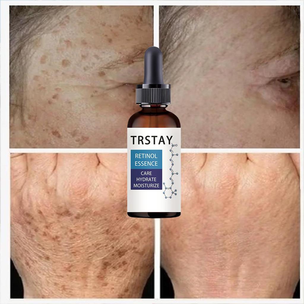 Black Spot Correction Face Cream, Used For Facial And Body Skin Care, Contains Nicotinamide And Hyaluronic Acid