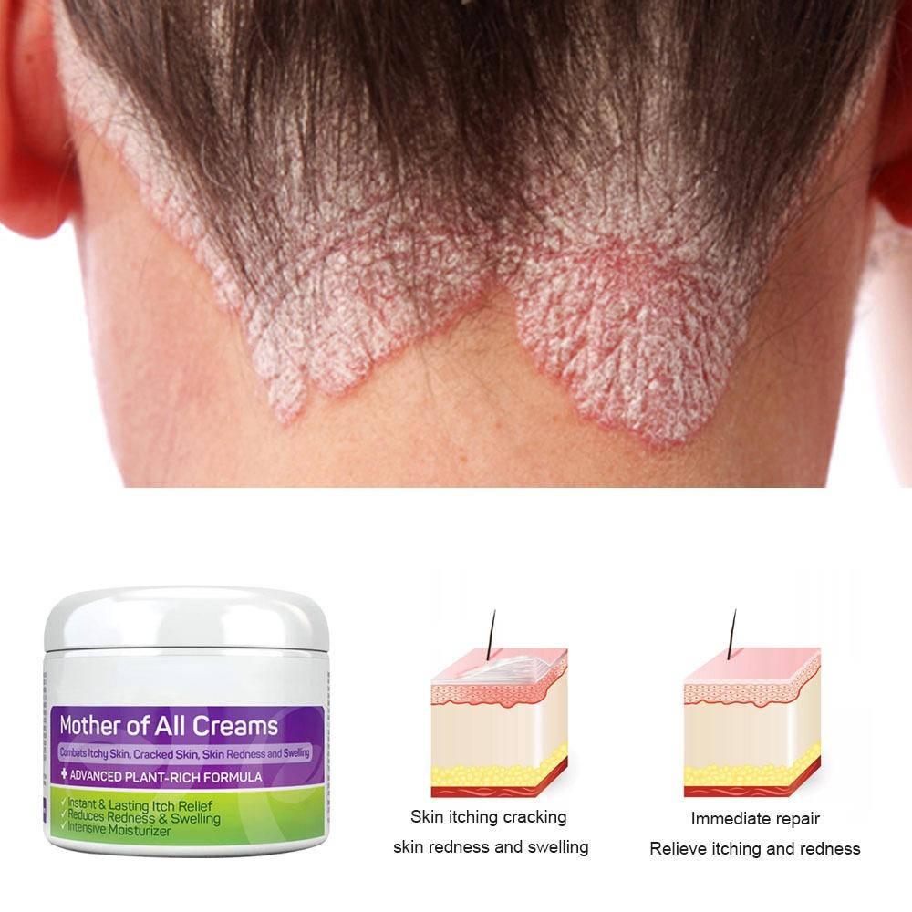 Skin Antipruritic Care Cream Body Moisturizing Repair Nourishing Cream