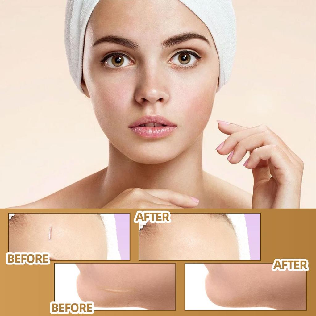 Skin Concealer Patch, Skin Scar Acne Mark Cover Patch Skin Color Patch Waterproof