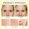 WIIEEY Star Pimple Patch Fade Down Pimple Pimple Marks Clean Face Closed Acne Portable Cartoon Pimple Patch