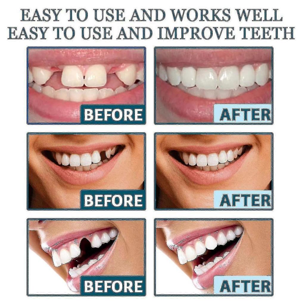 Adjustable Denture Kit With Snap-on Veneers, Cases, And Interdental Fillings - Straighten Teeth And