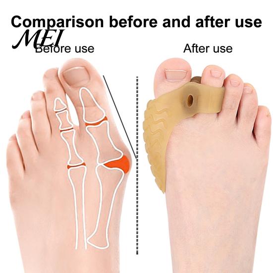 Anti-slip Toe Separator 1 Pair for Overlapping Toes, Soft SEBS Bunion Corrector, Double Double-hole Spacer Hole Foot Hallux Valgus, Breathable