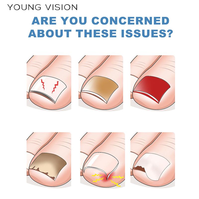 Plasture de îngrijire a unghiilor de la picior Plasture de reparare a unghiilor de la picioare