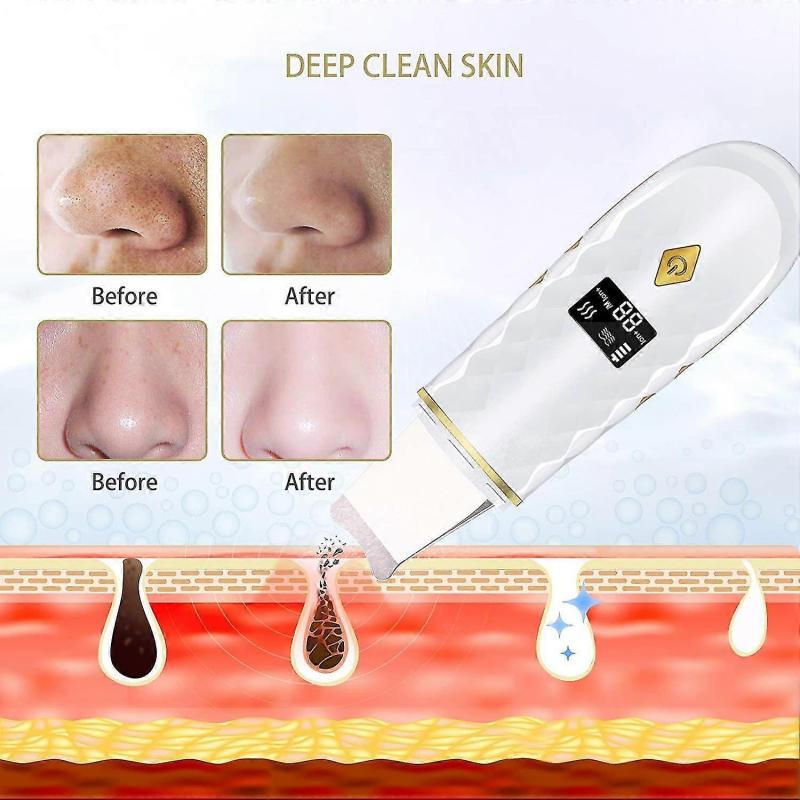 SHELLTON Skin Scrubber, Facial Skin Scrubber for Deep Cleaning & LCD Screen, Skin Spatula, Blackhead Remover, Pore Cleaner, Face Spatula with 4 Se