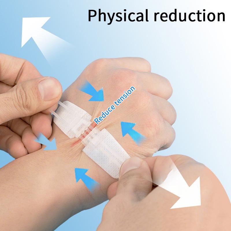 Plaster do zamykania ran na zamek błyskawiczny Plaster hemostatyczny Szybkie szwy na rany Bandaże przenośne na zewnątrz do pielęgnacji ran