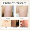 Skin Soothing Spray , Anti-acne , Relieves Redness And Itching , Soothing Water , Gently Soothes The Skin Without Irritation ,30ML
