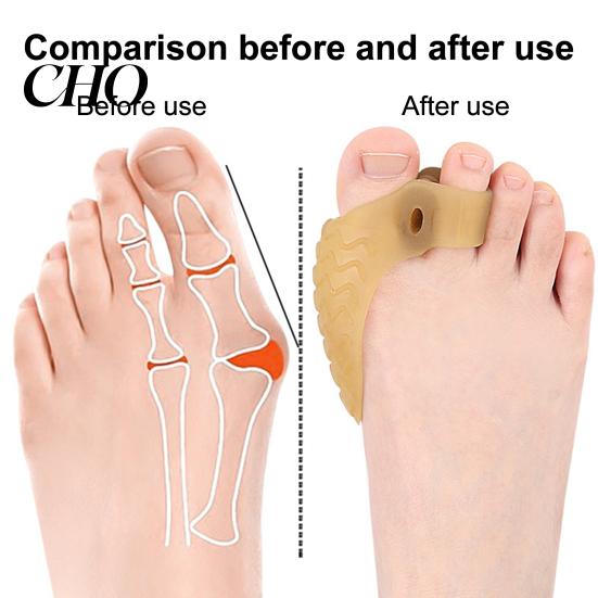 Sensitive Skin Toe Spacer 1 Pair Separator for Overlapping Toes, Soft SEBS Bunion Corrector, Double Silicone Hole Foot Hallux Valgus, Breathable
