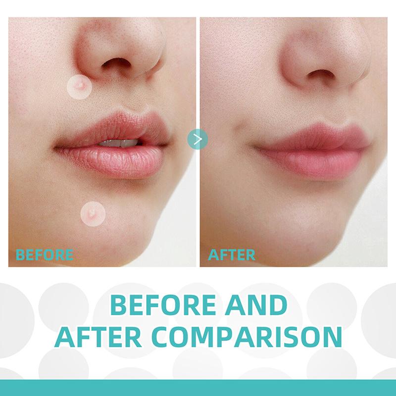 Acne Patch Facial Repair Acne Clean Pores Moisturize And Smooth Skin Acne Patch Facial Stickers Skin Care Tools