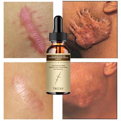 Cream Skin Wound Cream Burning Fading Cream Surgery Repair Scar Skin Care  Skin Whitening Cream Crema Para Manchas De La Cara