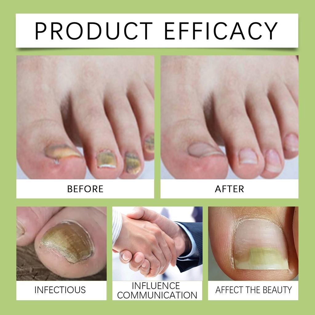 Toenail Fungus TreatmentExtra Strong  NailTreatment  Nail Care TreatmentExtra Strong For Thick  Discolored And Damaged Nails 30ml