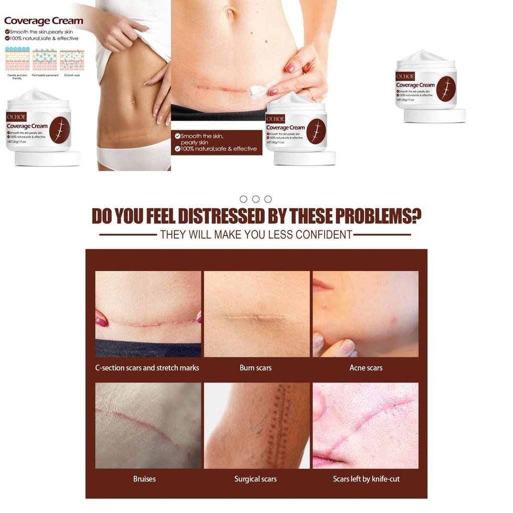 Ouhoe Scar Repair Cream For Effective Skin Scar Reduction And Healing Solutions