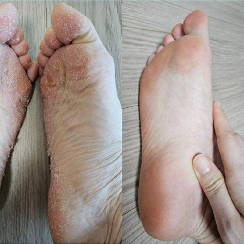 Perorin Foot Exfoliating Pack 1 Box (2 Servings)