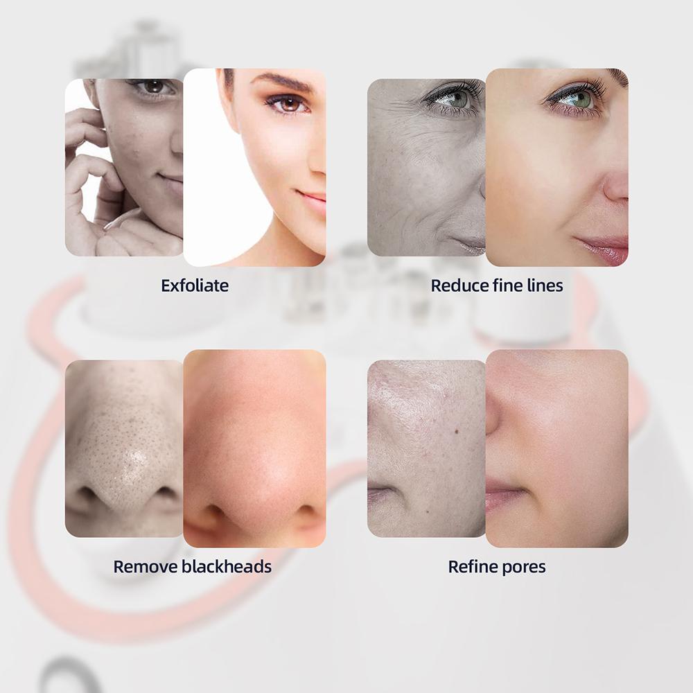 Foreverlily Diamond Facial Peeling Machine Home Use Professional Microdermabrasion Nano Water Spray Exfoliation Beauty Machine