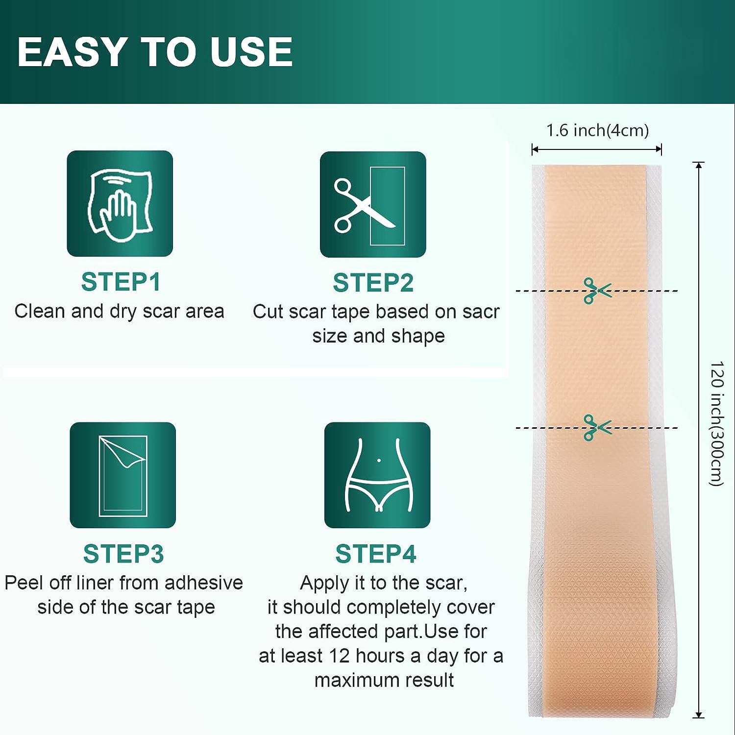 1 шт. 150 см силиконовый гелевый пластырь для лечения шрамов лента для удаления акне — фото 8