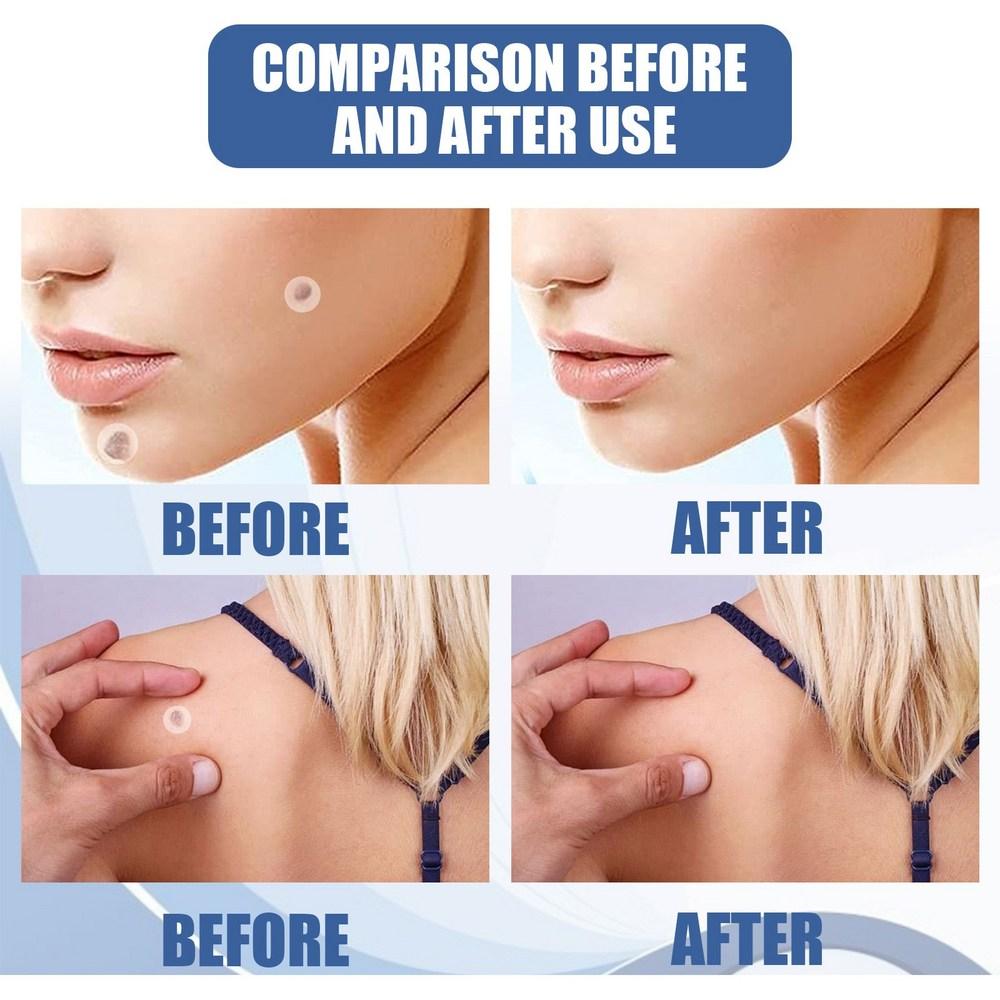 Spot Patch, Blemishes, Freckle Removal Patch, Pigmentation, Melatoning Patch 144 Sheets