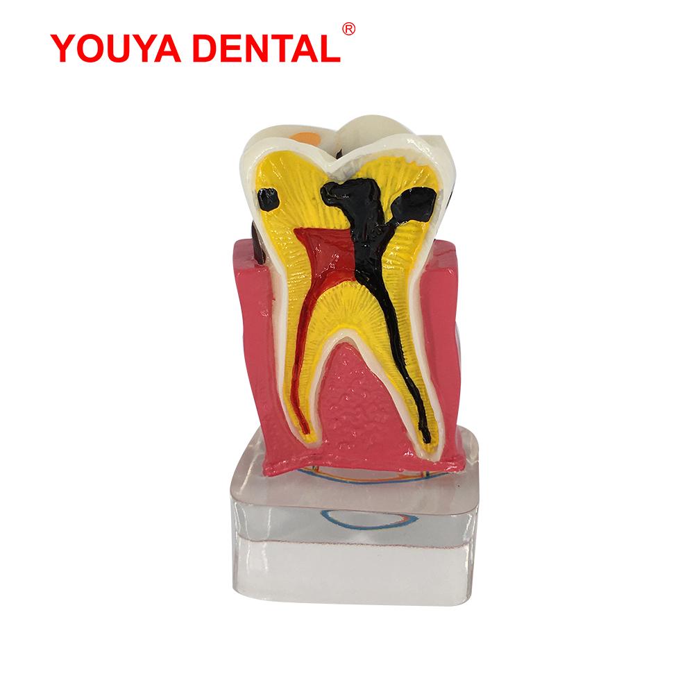 Dental Model Resin 4times Transparent Molar Anatomy Teeth Modeling With Nerves Medical Science Oral Dentist   Dentistry Products