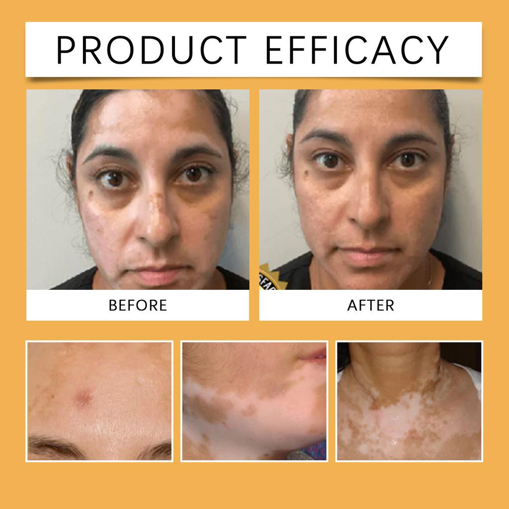 Skin Balance Cream , Skin Pigmentation , Vitiligo , Yellowish-brown Care , Inflammation , Soft And Moisturizing Texture , Light And Easy To Absorb.