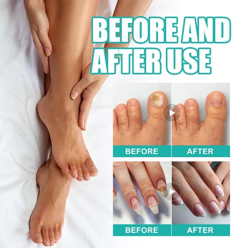 Spray de Soin des Ongles Ximonth Pour des Ongles Plus Forts et Élimination des Odeurs 30ml Solution Efficace