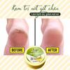 Banana Foot Cream 30g – Cracked Heel Repair, Moisturizing & Nourishing, Antibacterial Foot Balm – Made In Thailand
