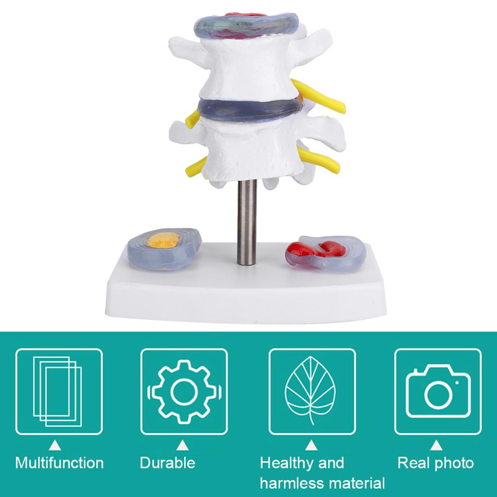 Anatomical Lumbar Disc Herniation Demonstration Model Human Spine School Training Supplies
