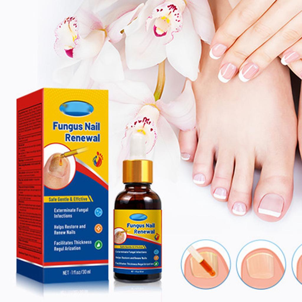 Moisturizing Hand, Foot, Nail Treating Toenails Is Suitable For Nail Care For Toes With Thick, Yellow, And Damaged Nails Liquid 30ml