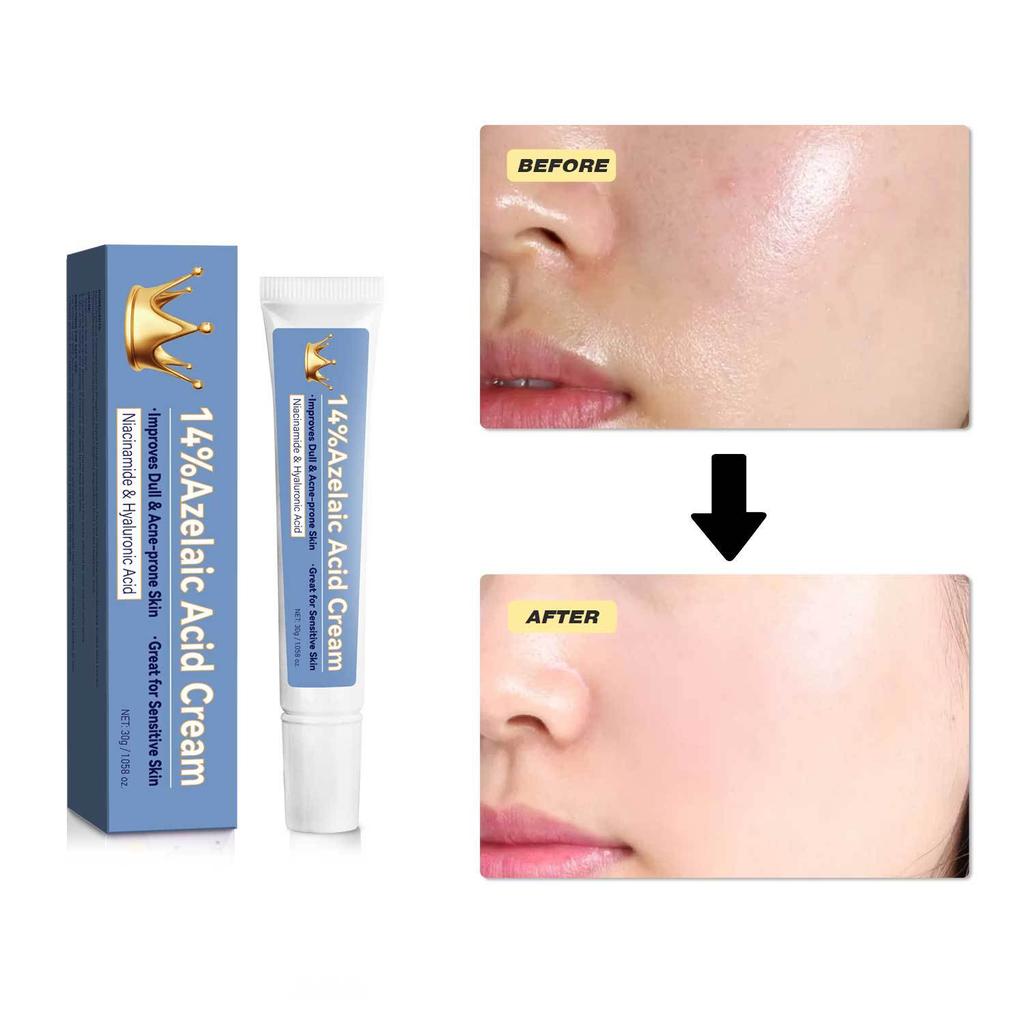 Azelaic Acid Face Cream, 30 G