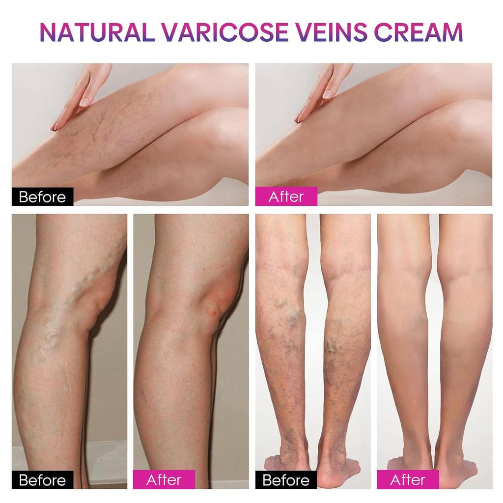 Leg Treatment Cream Legs Topical Repair Skin Moisturizing Applicator Massage Treatment Cream