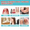 16pcs/box Foot Nail Repair Patch Grey Fungal Nail Thicken Soft Paronychia Infection Hand Nail Correction Sticker Ingrown Toenail