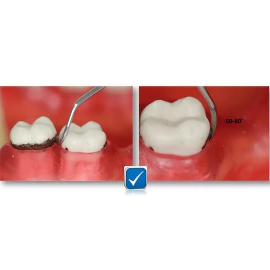GDC Sickle Scalers Posterior #6 (S129)