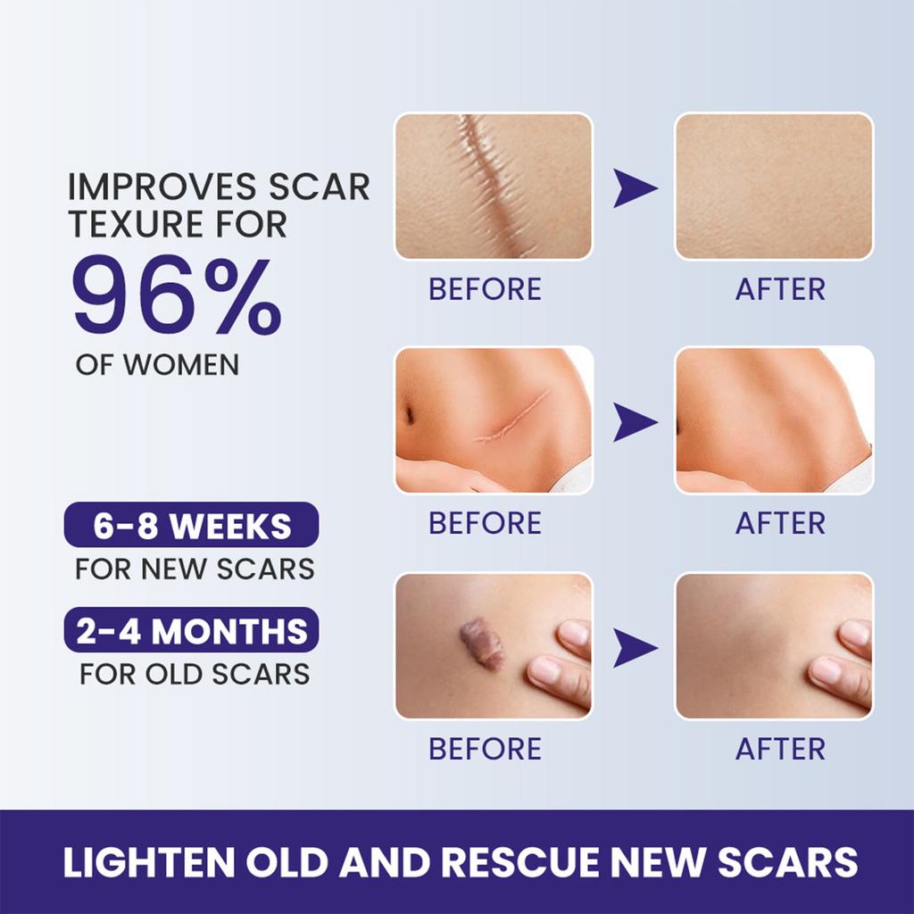 Silicone Scar Cream, Scar Gel, Fading Scar, Nourishing And Promoting Skin Regeneration Care Cream