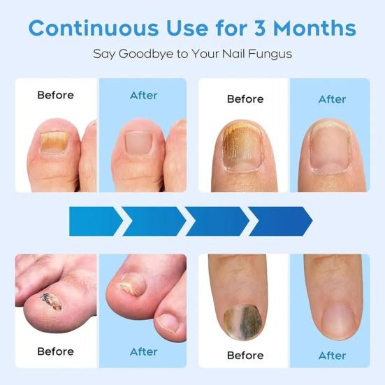 Bærbar Neglesoppbehandling Lys 22-LED UV-lysterapi Sammenleggbar U-formet Design 470nm Blått + 905nm Infrarødt Neglekunst Fototerapimaskin