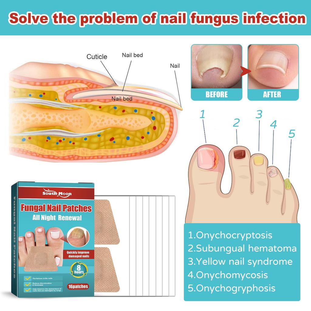 16pcs/box Foot Nail Repair Patch Grey Fungal Nail Thicken Soft Paronychia Infection Hand Nail Correction Sticker Ingrown Toenail