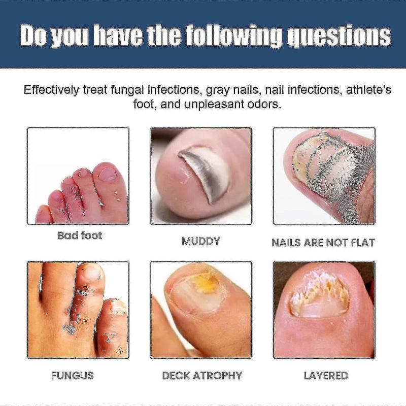 South moon onychomycosis repair spray moisturizes and cleans odor onychomycosis soft nail dry na