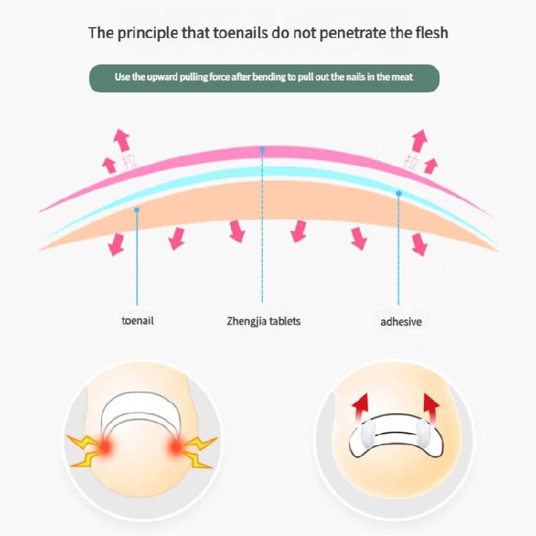 Titaniums Alloy Ingrown Toenail Treatments Ingrown Toenail Removal Kit Ingrown Toenail Corrector,Nail Correction Tools