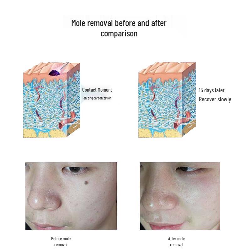 Rechargeable RF Laser Spot & Mole Removal Pen