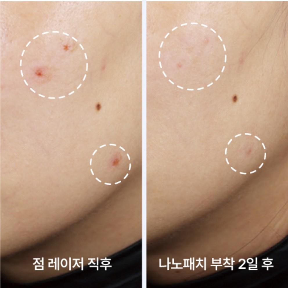 [CELLOIT] Nano Patch Spot Patch Acne Pimple Patch (11mm), 16 Patches, 1 Pack