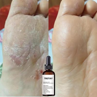 5ML/15ML/30ML/50ML/astaxanthin Essence Hand Foot Moisturizing Hyaluronic Acid Essence Deep Repair Nourishing Skin Care